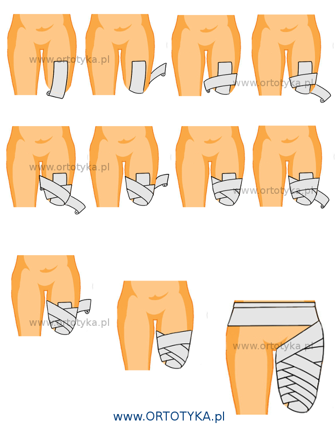 kikut_amputacja_uda_kolanem_podudzie_podudzia_bandażowanie_ototyka_protezownia_warszawa_proteza_nogi
