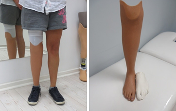 proteza podudzia pokrycie